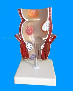 Модел лезии на ректума вътрешна и външна аноректальная модел патология на дебелото черво